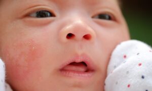 Baby Acne: Causes, Symptoms, and Treatment